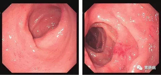 萎縮性胃炎不可怕，只要真正了解它