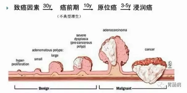 體檢查出腸息肉一定要切除！ 95%腸癌由它演變而來